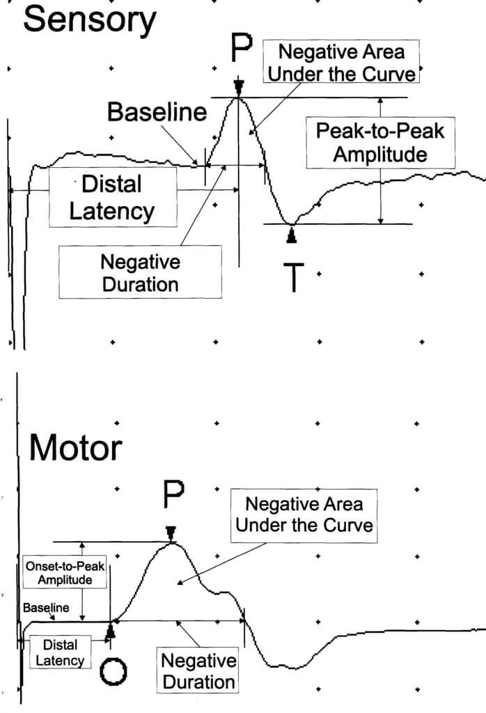 Taking the Mystery Out of an EMG/NCS Report - Part 1 - EMG Solutions